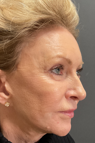 Blepharoplasty