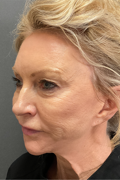 Blepharoplasty