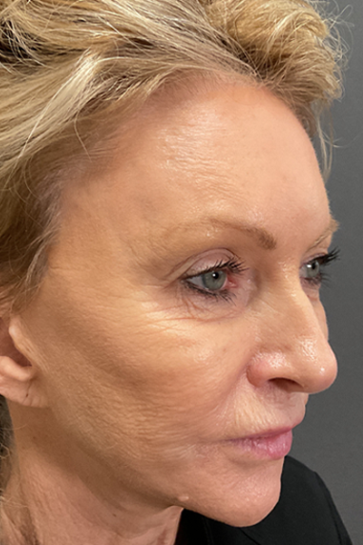 Blepharoplasty