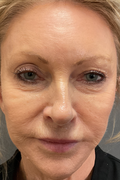 Blepharoplasty