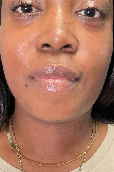 Neck/Chin Liposuction