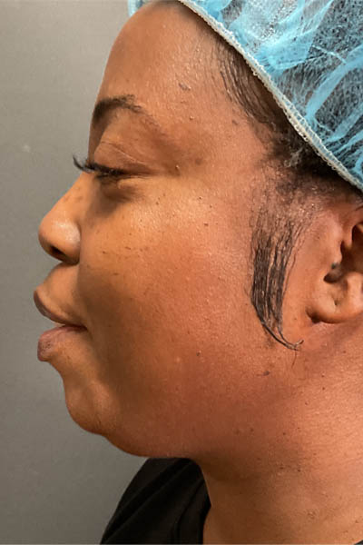 Neck/Chin Liposuction