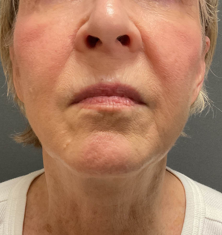 Awake Facelift