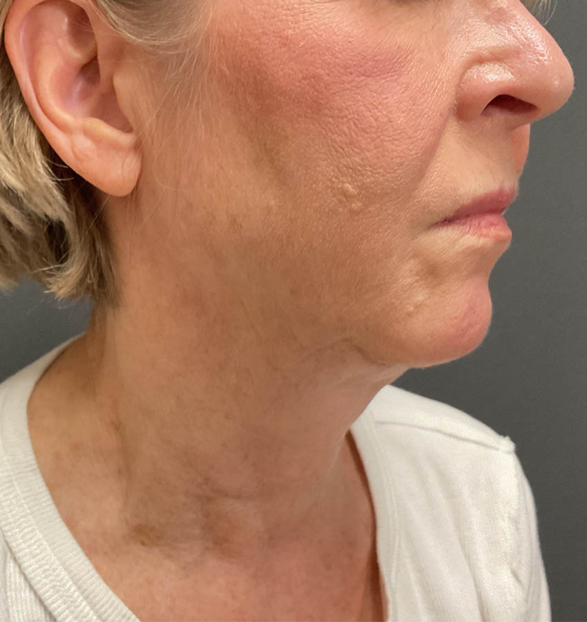 Awake Facelift