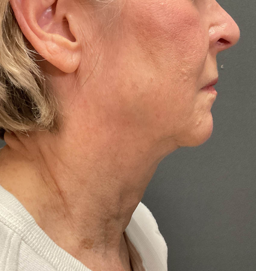 Awake Facelift