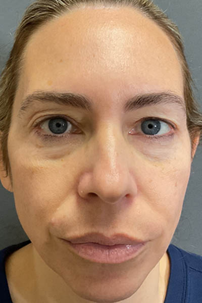 Blepharoplasty