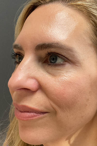 Blepharoplasty