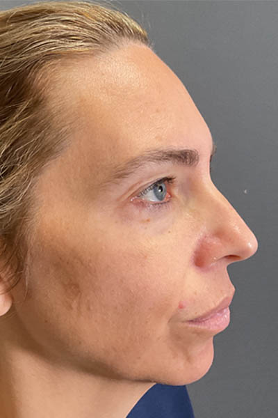 Blepharoplasty