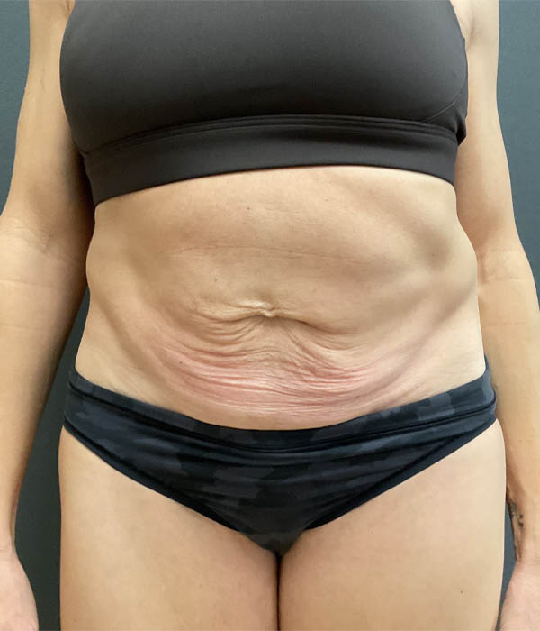Tummy Tuck