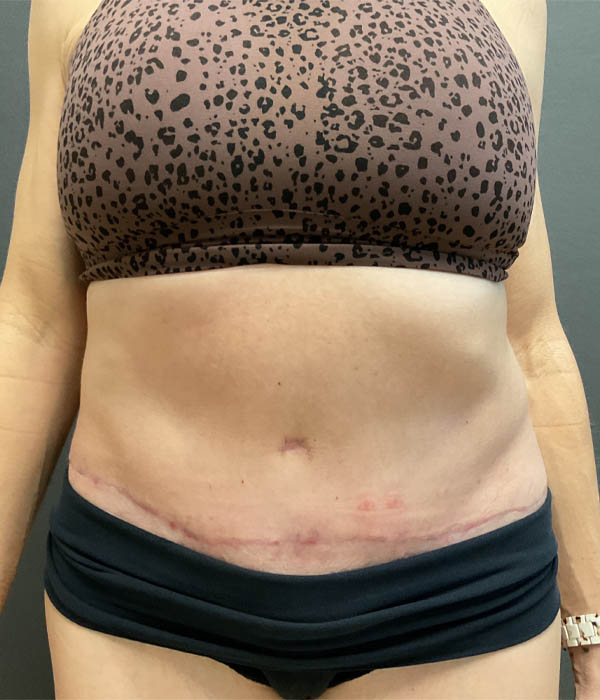 Tummy Tuck