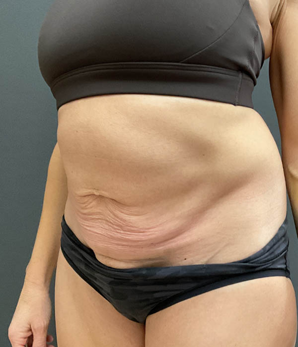 Tummy Tuck