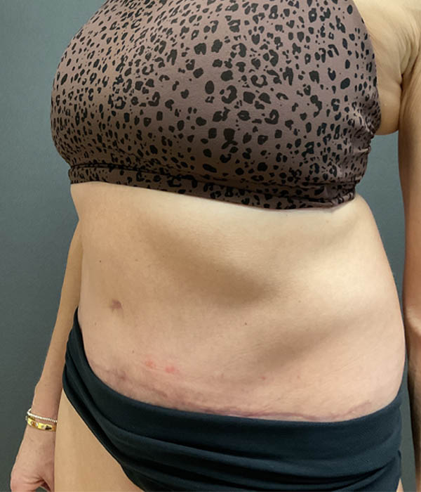 Tummy Tuck