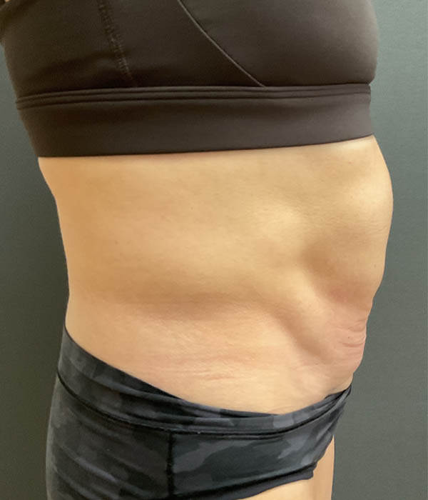 Tummy Tuck