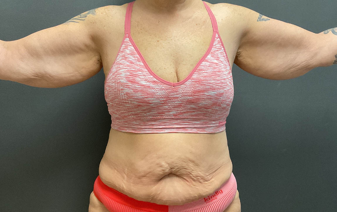 Arm Lift