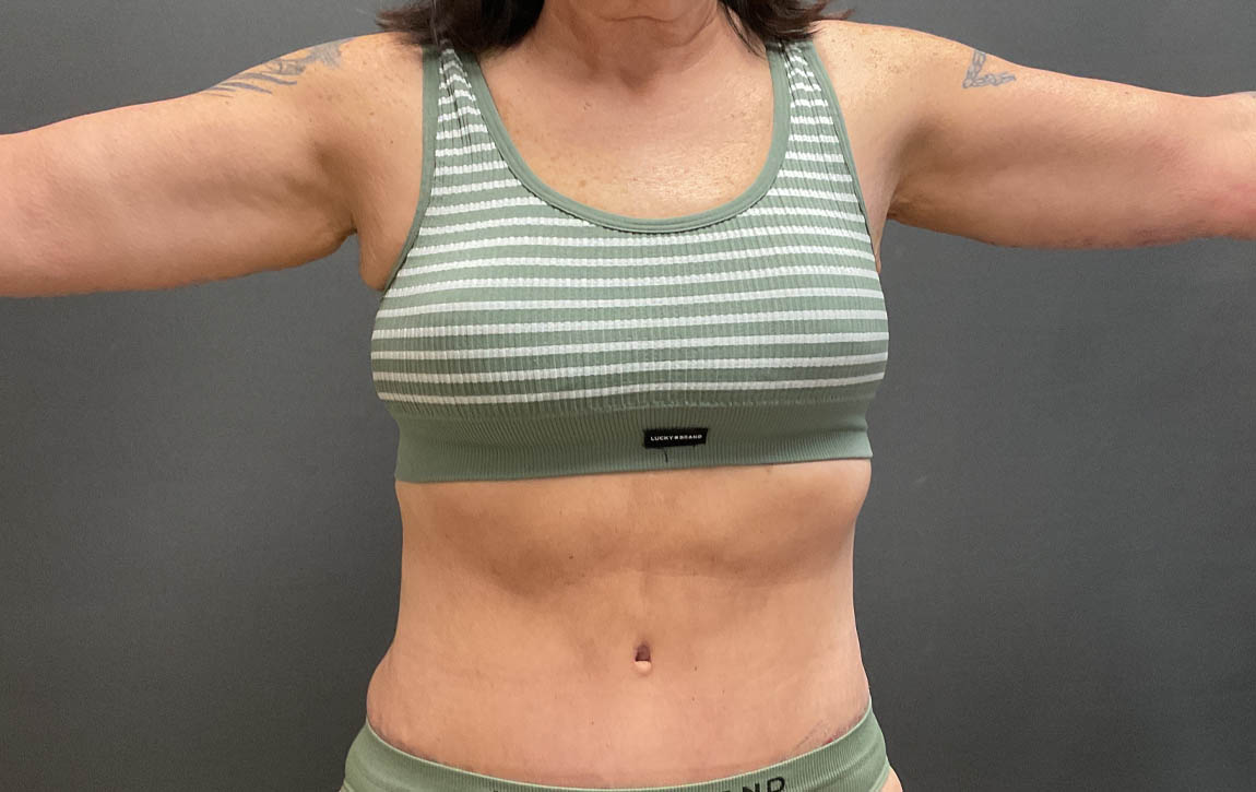 Arm Lift