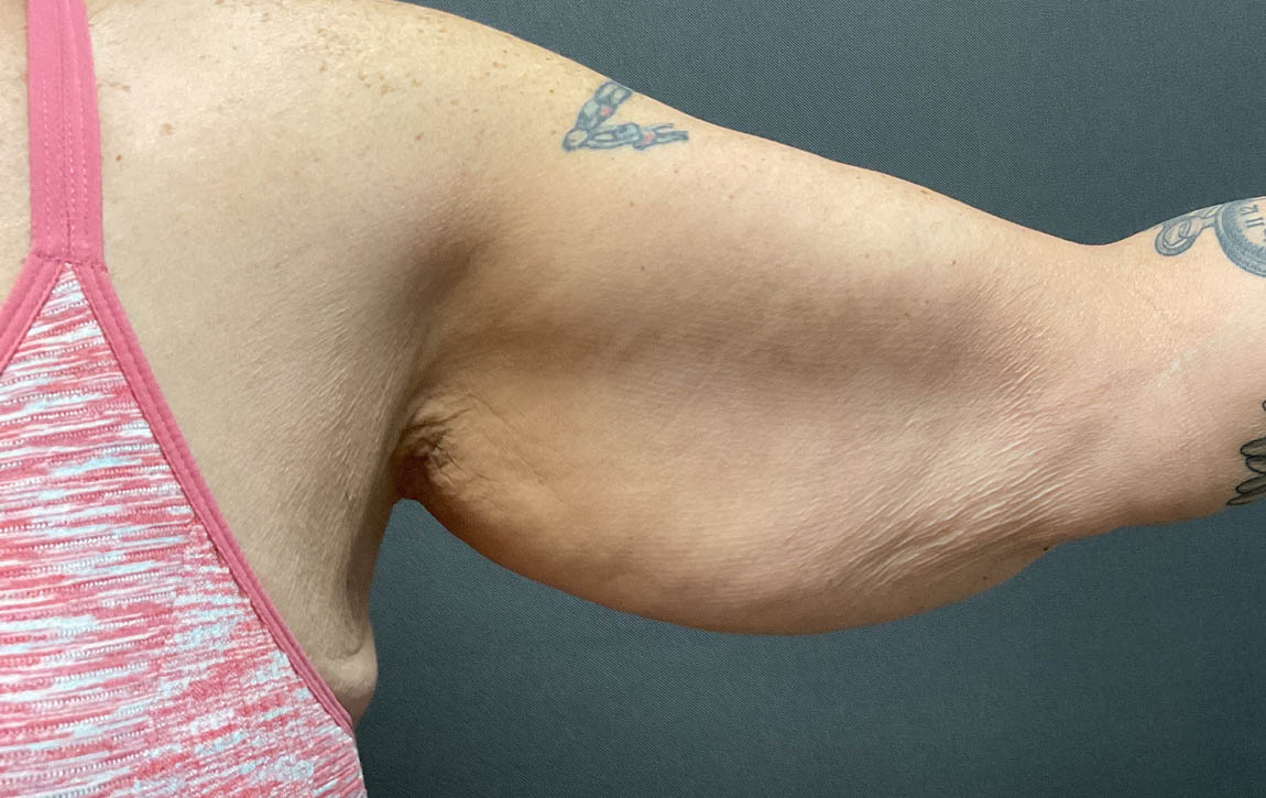 Arm Lift