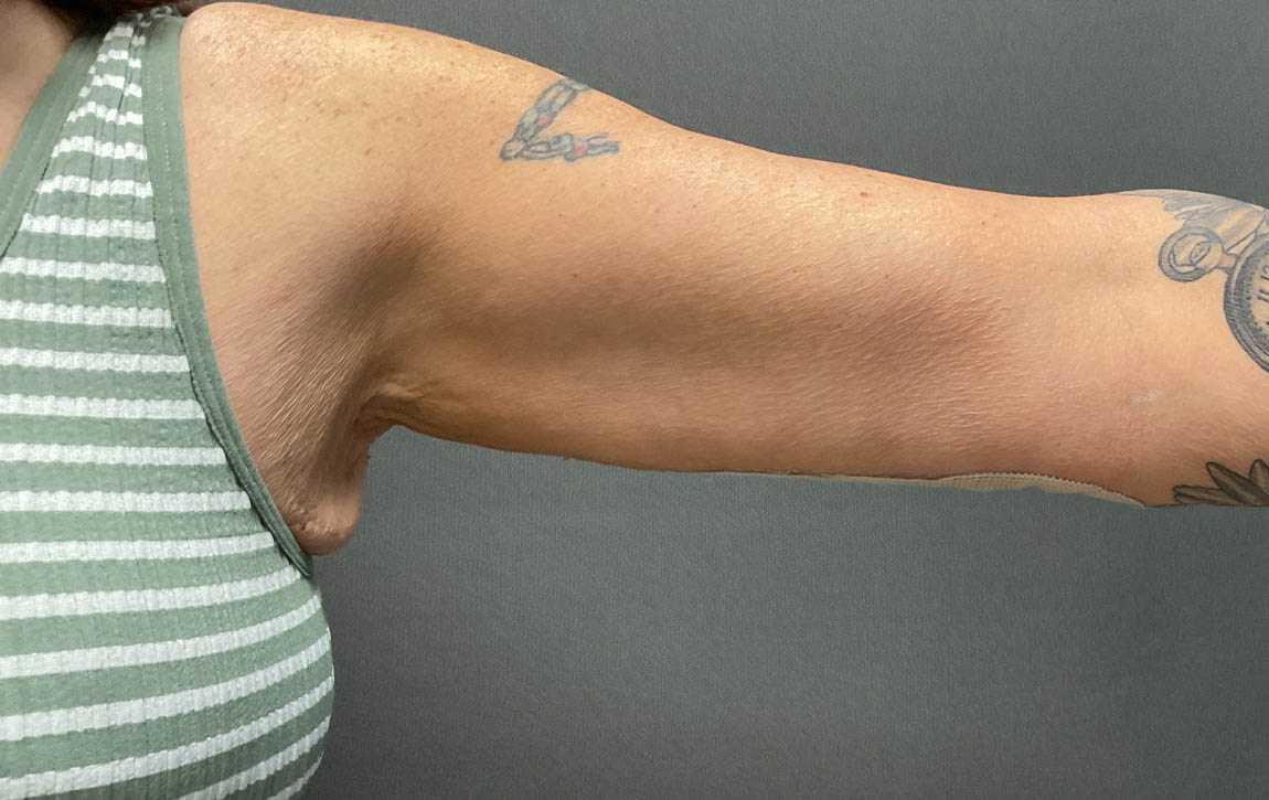 Arm Lift