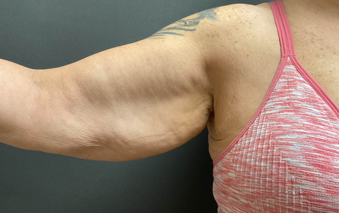 Arm Lift