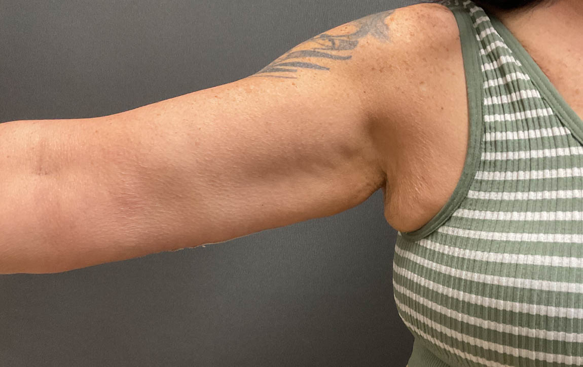 Arm Lift