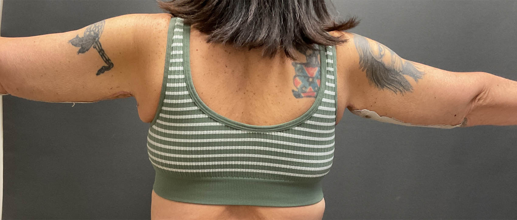 Arm Lift