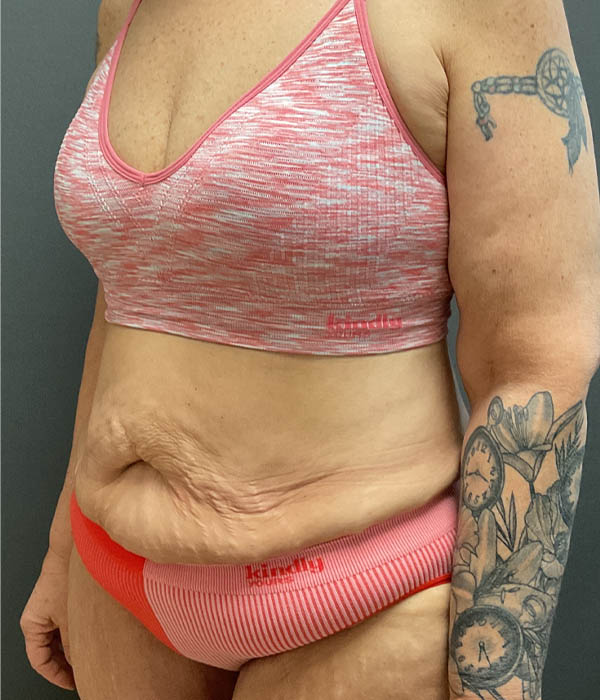 Tummy Tuck