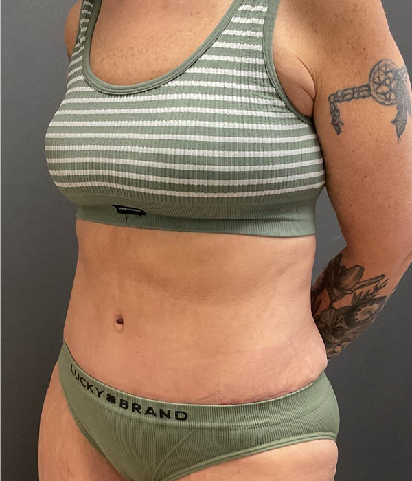 Tummy Tuck