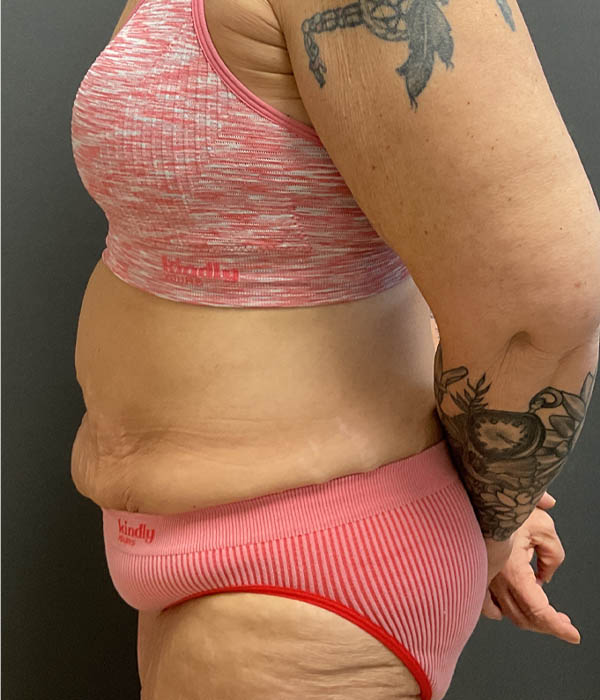 Tummy Tuck