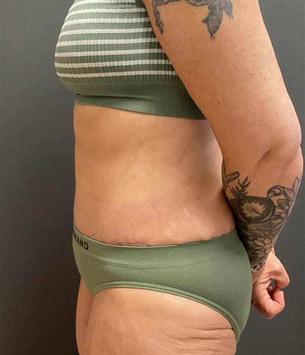 Tummy Tuck