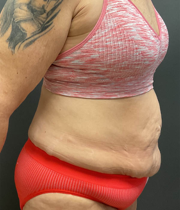 Tummy Tuck