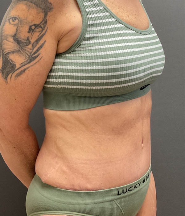 Tummy Tuck