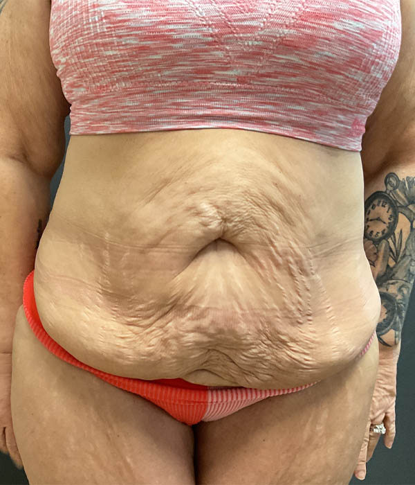 Tummy Tuck
