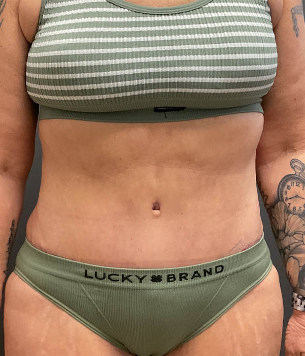 Tummy Tuck