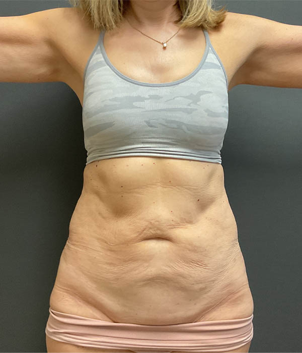 Tummy Tuck