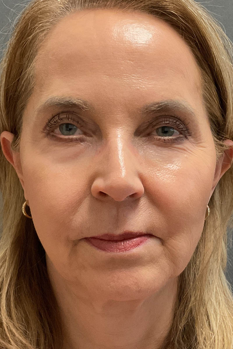 Facelift