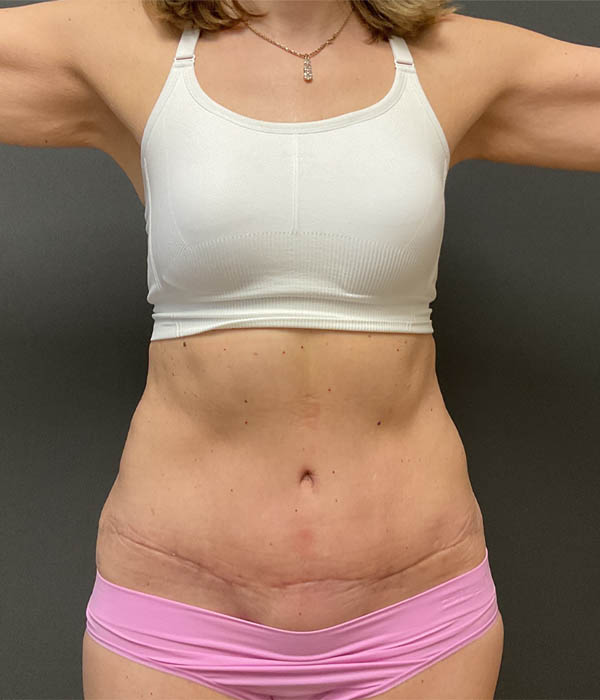 Tummy Tuck