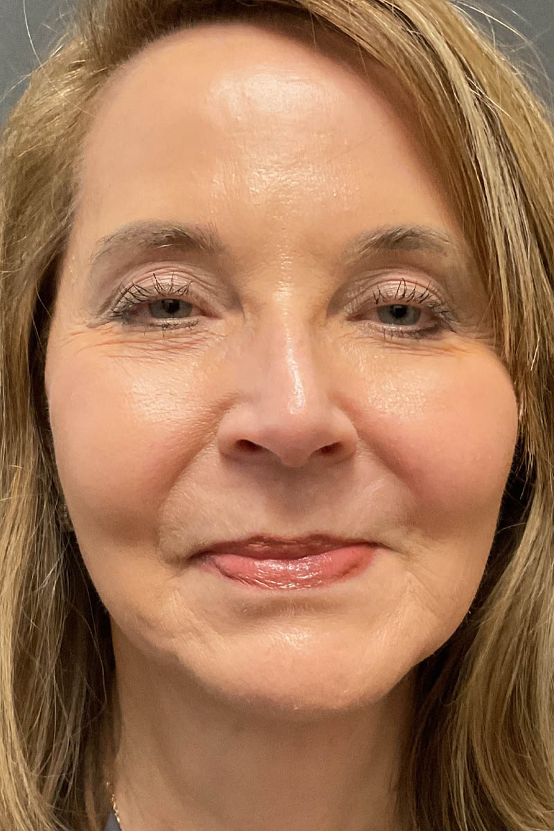 Facelift