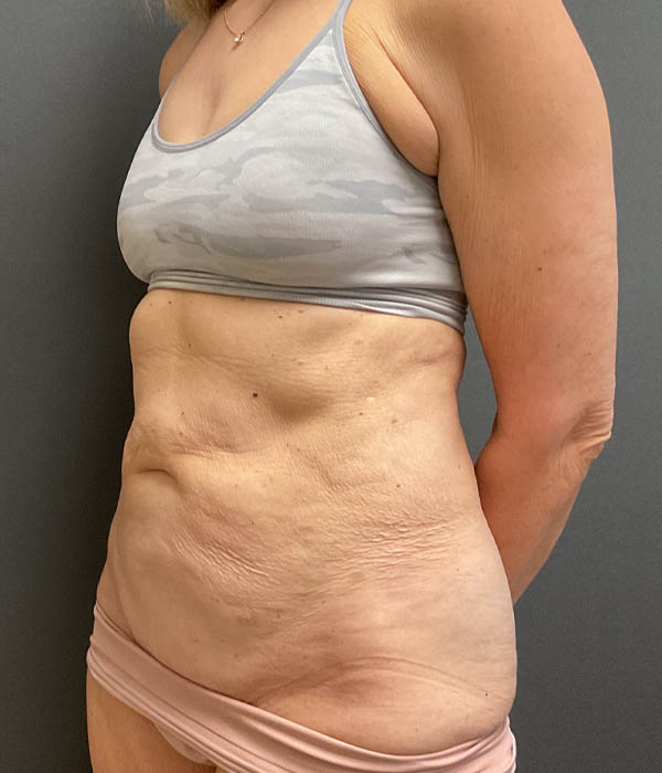 Tummy Tuck