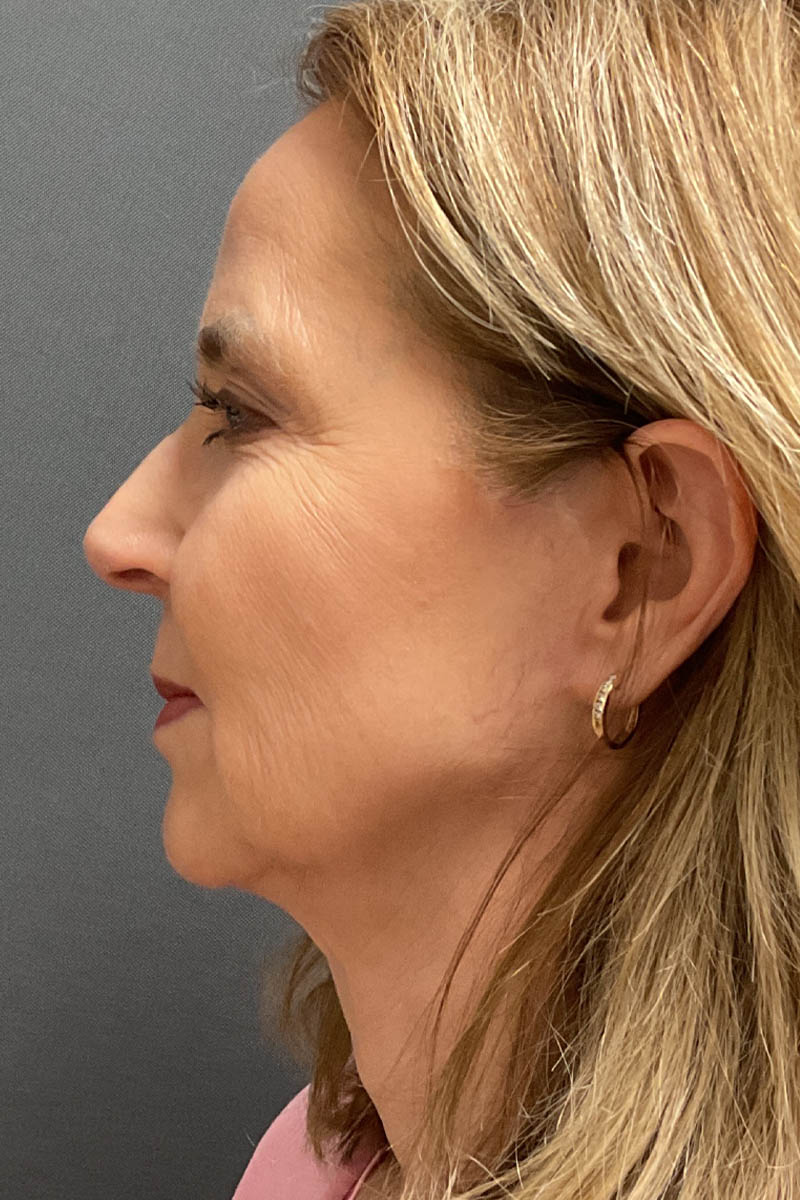 Facelift