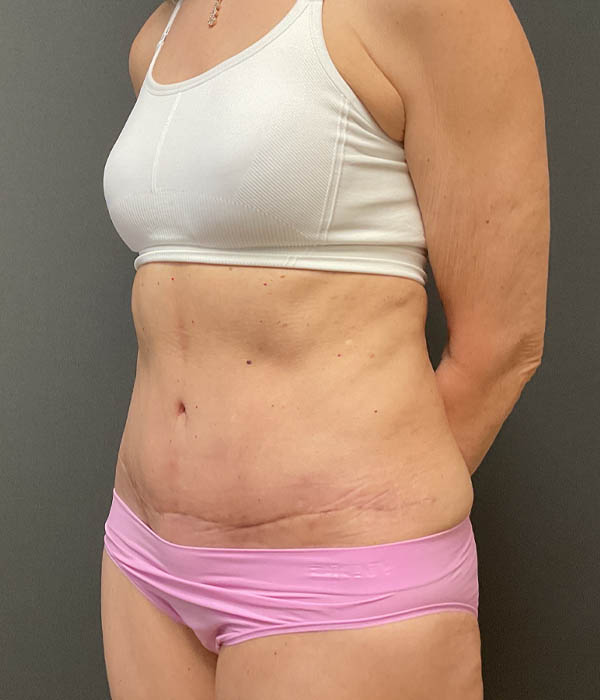 Tummy Tuck