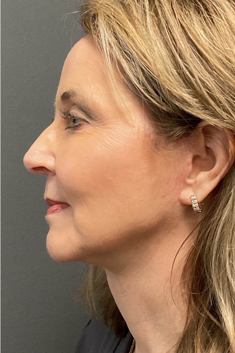 Facelift