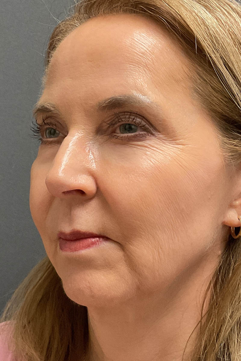 Facelift