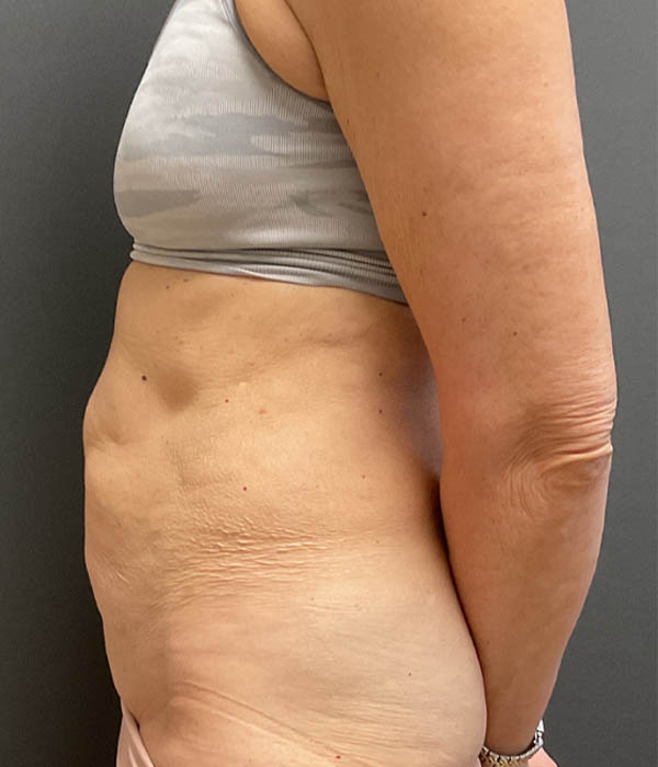 Tummy Tuck