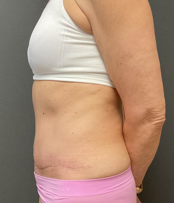 Tummy Tuck