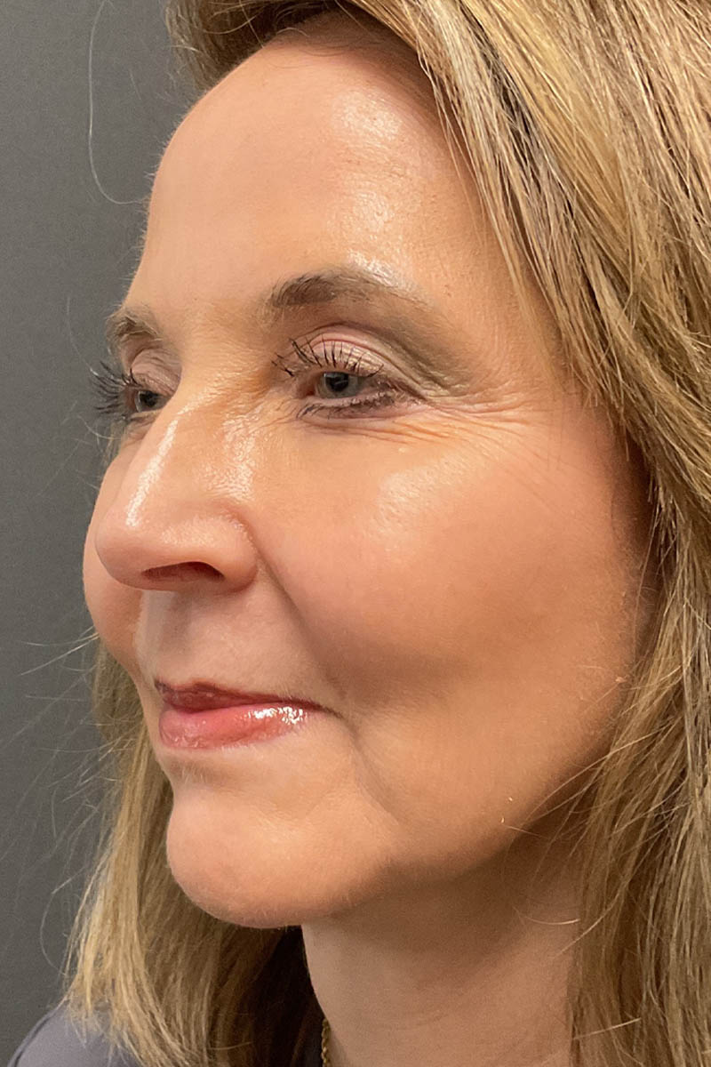 Facelift