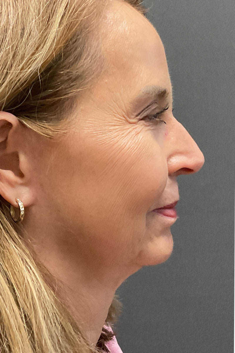 Facelift