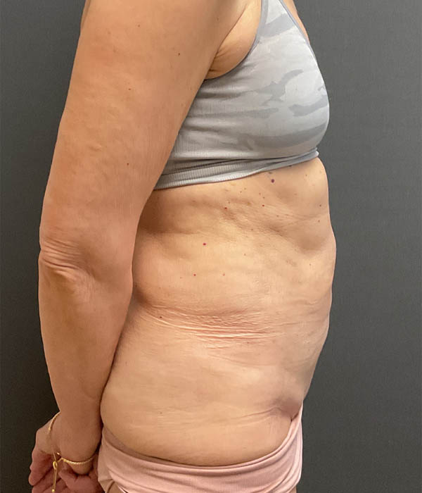 Tummy Tuck