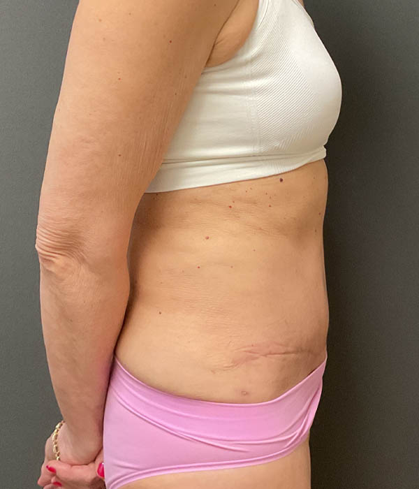 Tummy Tuck