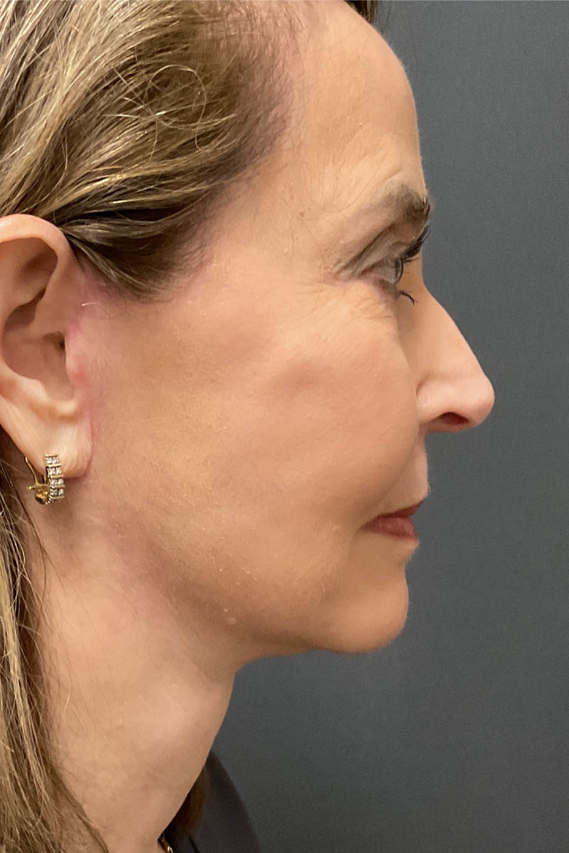 Facelift