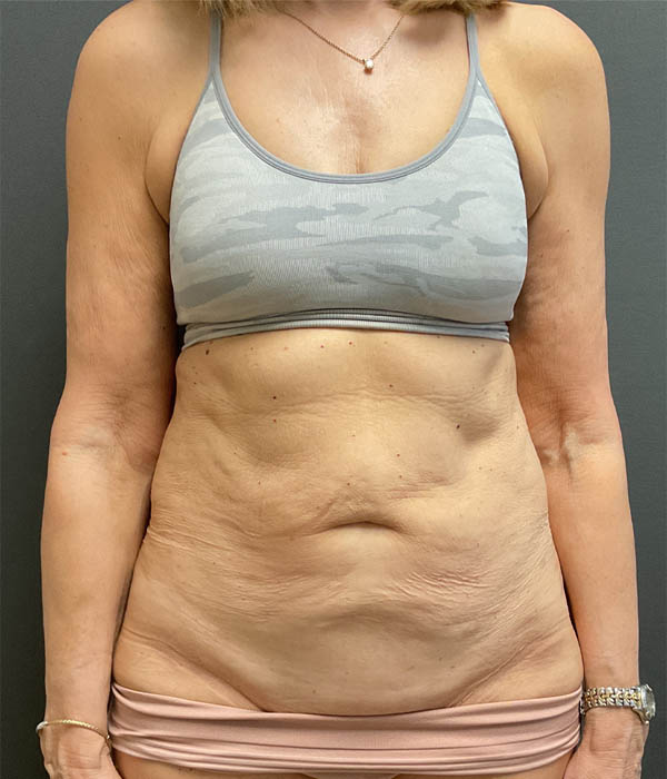Tummy Tuck