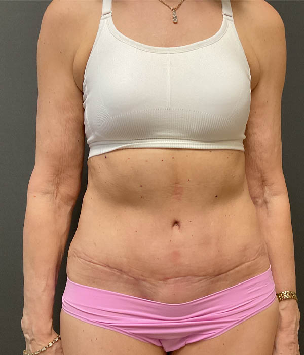 Tummy Tuck